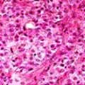 Mesothelioma Cancer