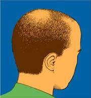 BALDNESS-HAIR_LOSS