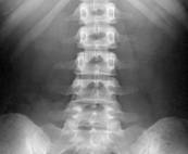 Renal Stones