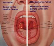 TONSILLITIS