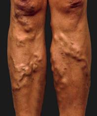 VARICOSE_VEIN