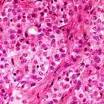 Mesothelioma Cancer